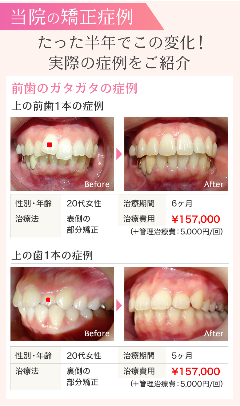 当院の矯正症例 たった半年でこの変化！実際の症例をご紹介 前歯のガタガタの症例 20代女性 表側の部分矯正 治療期間6ヶ月 治療費用157,000円 上の歯1本の症例 20代女性 裏側の部分矯正 治療期間5ヶ月 治療費用157,000円