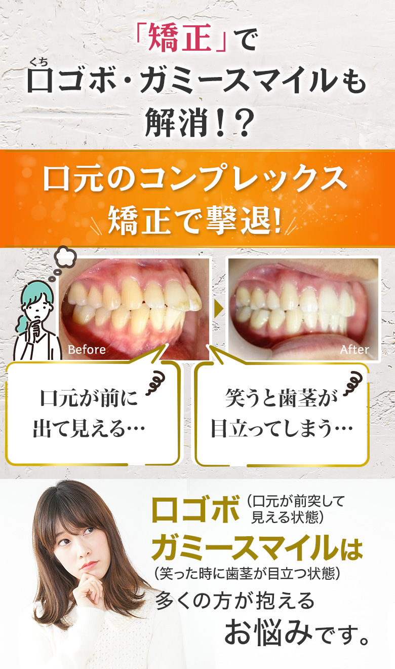 矯正でロゴボ・ガミースマイルも解消！？口元のコンプレックス矯正で撃退！口元が前に出て見える…笑うと歯茎が目立ってしまう…ロゴボ・ガミースマイルは多くの方が抱えるお悩みです
