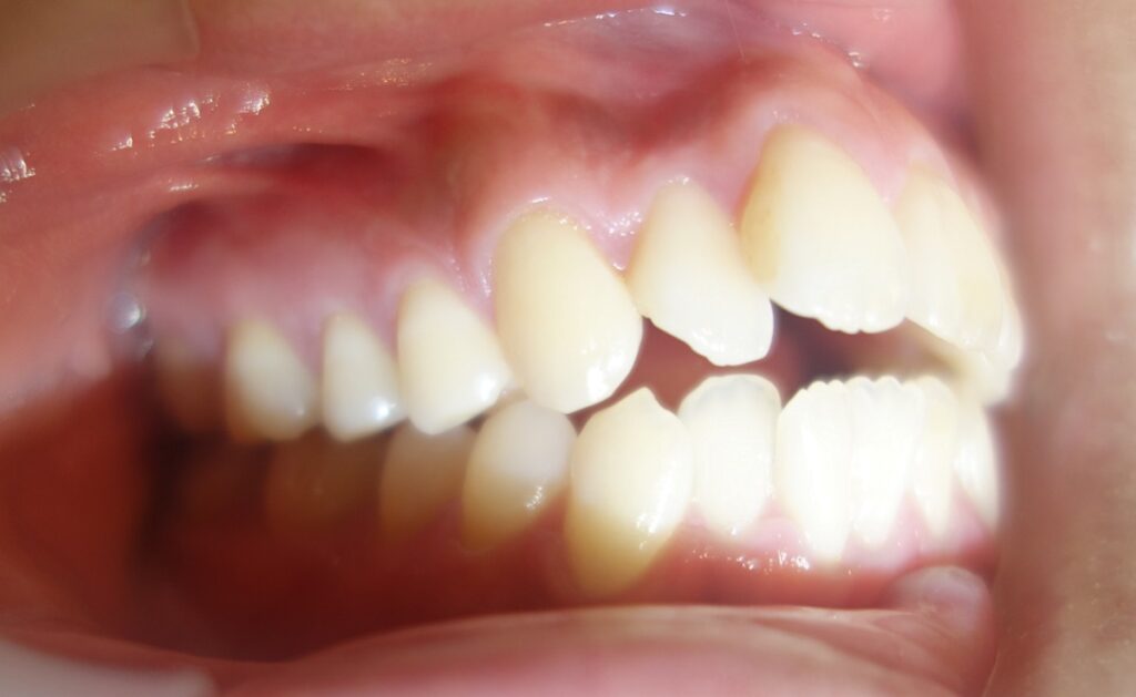 前歯６本の部分矯正の症例