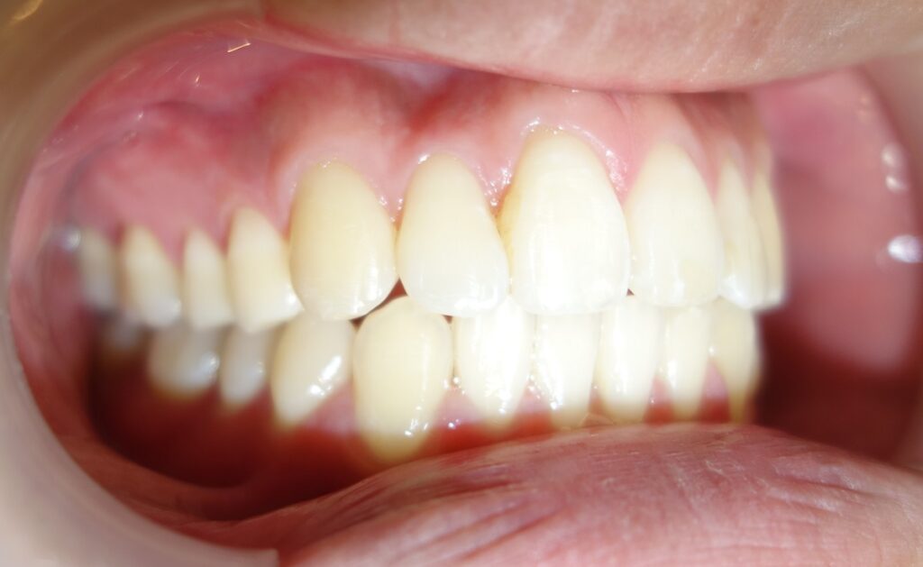 前歯６本の部分矯正の症例