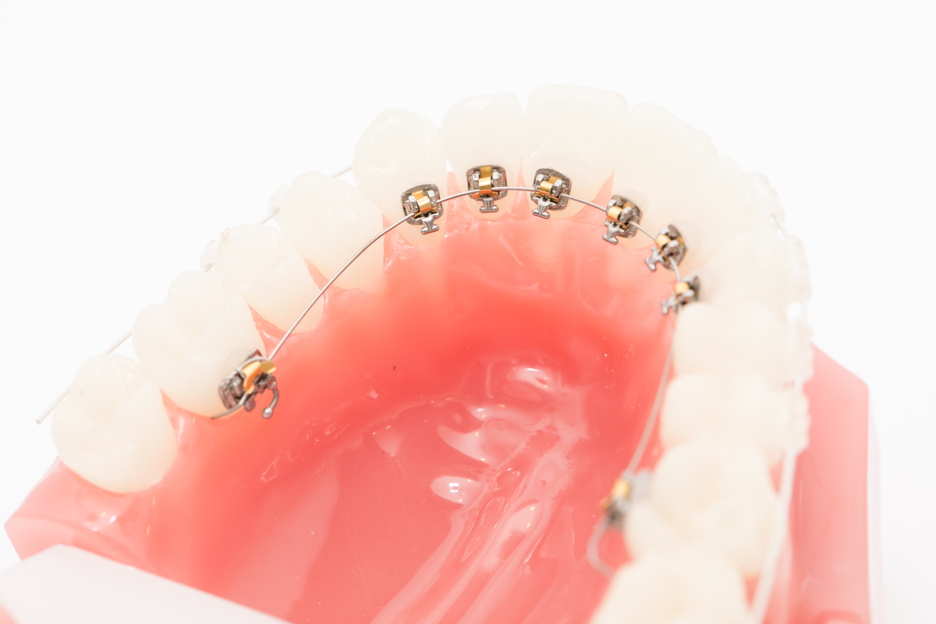 治療期間で選ぶなら「ワイヤー」