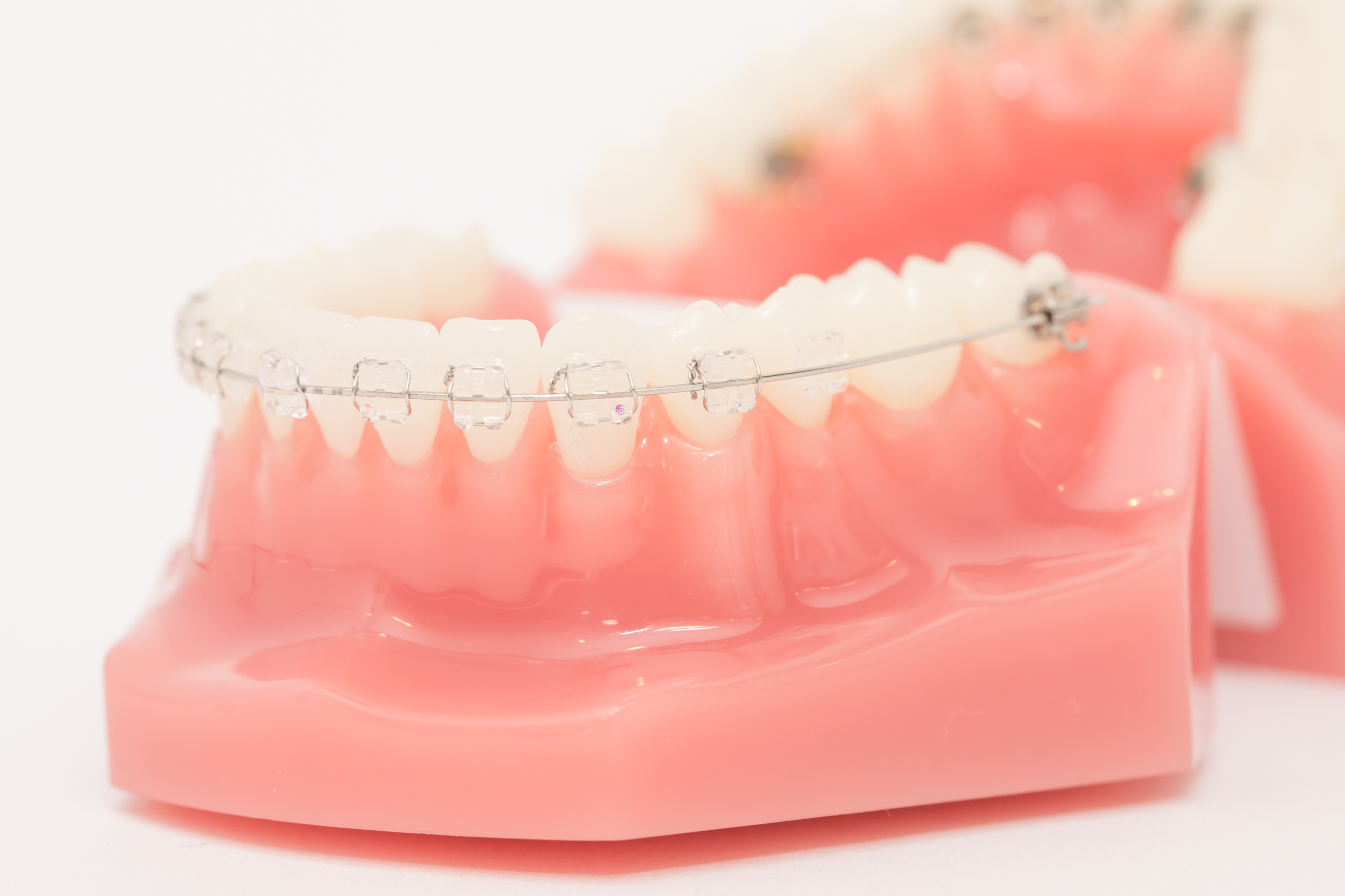 費用で選ぶなら「ワイヤー」