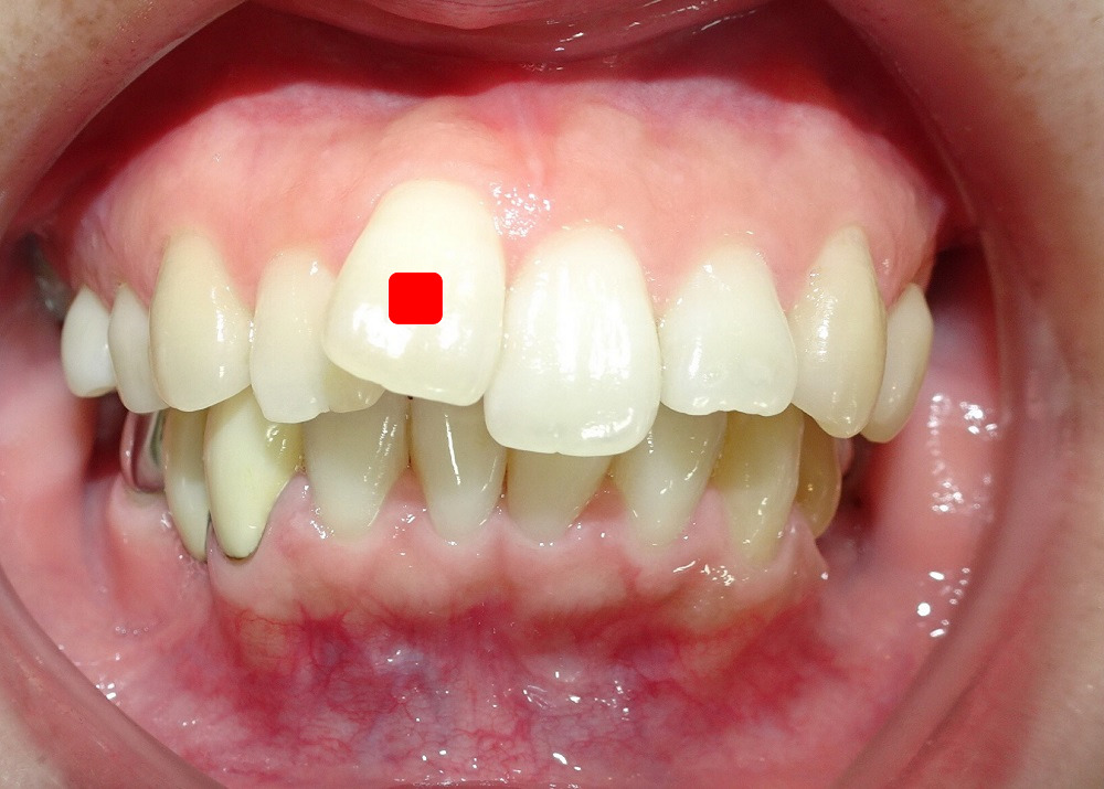 前歯1本の矯正症例