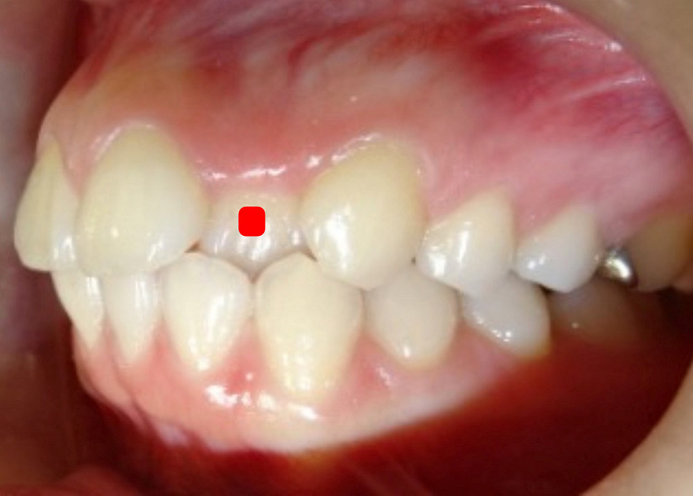 前歯1本の矯正症例